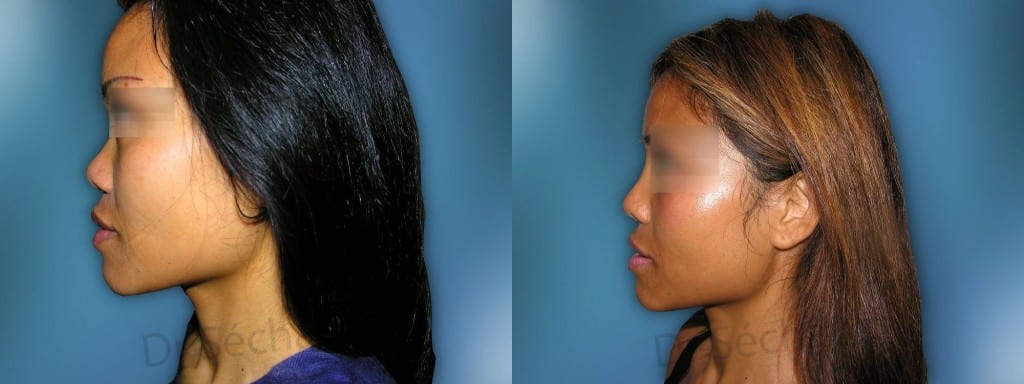 Rhinoplastie Ethnique Des Nez Noirs Asiatiques